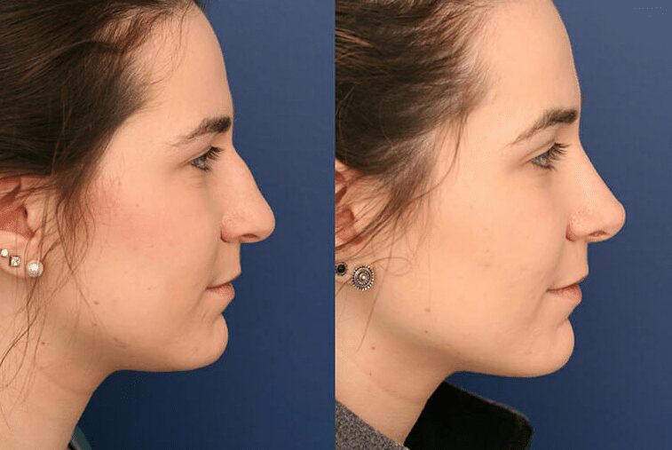 Driving Home After Rhinoplasty - Is It Safe